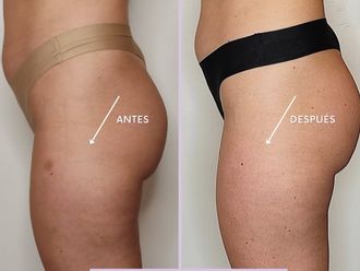 Criolipólisis antes y después - 848687
