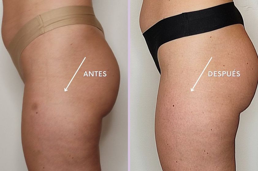 Criolipólisis antes y después - 848687