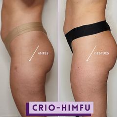 Criolipólisis - Centro IMEL