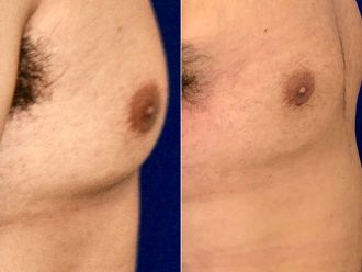 Liposucción antes y después - 878214