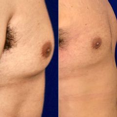 Liposucción - Dr. Alejandro Silvestre