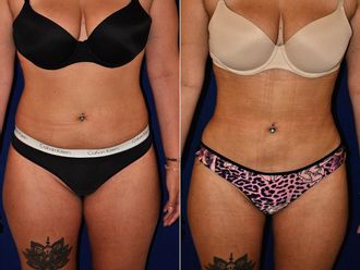 Liposucción antes y después - 878216
