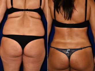 Liposucción antes y después - 878218