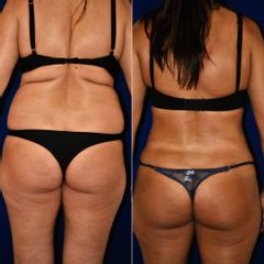 Liposucción Ultrasónica - Dr. Alejandro Silvestre