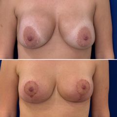 Mastopexia - Dr. Alejandro Silvestre