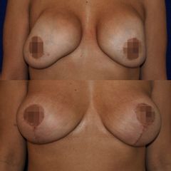 Mastopexia - Dr. Alejandro Silvestre