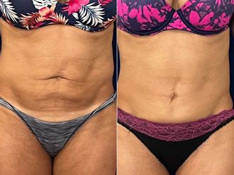 Dermolipectomía antes y después - 878222