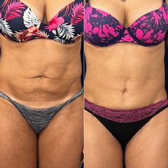 Dermolipectomia - Dr. Alejandro Silvestre