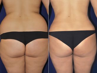 Lipoescultura antes y después - 878223