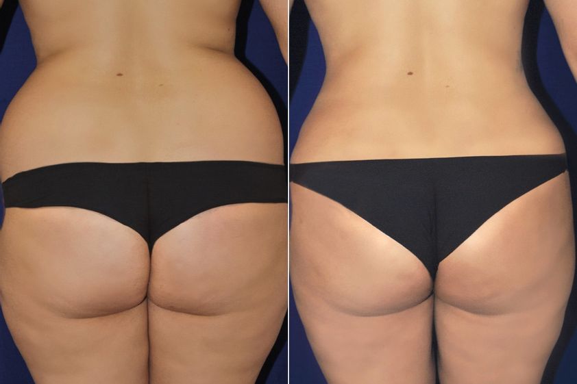 Lipoescultura antes y después - 878223