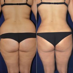 Lipoescultura - Dr. Alejandro Silvestre