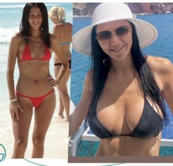 Aumento Mamas - Dr. Alejandro Silvestre