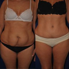 Abdominoplastia - Dr. Alejandro Silvestre