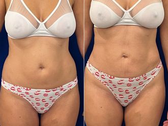 Liposucción antes y después - 878226