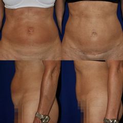 Dr. Alejandro Silvestre - Abdominoplastia