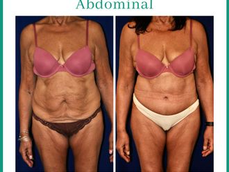 Abdominoplastía antes y después - 878959