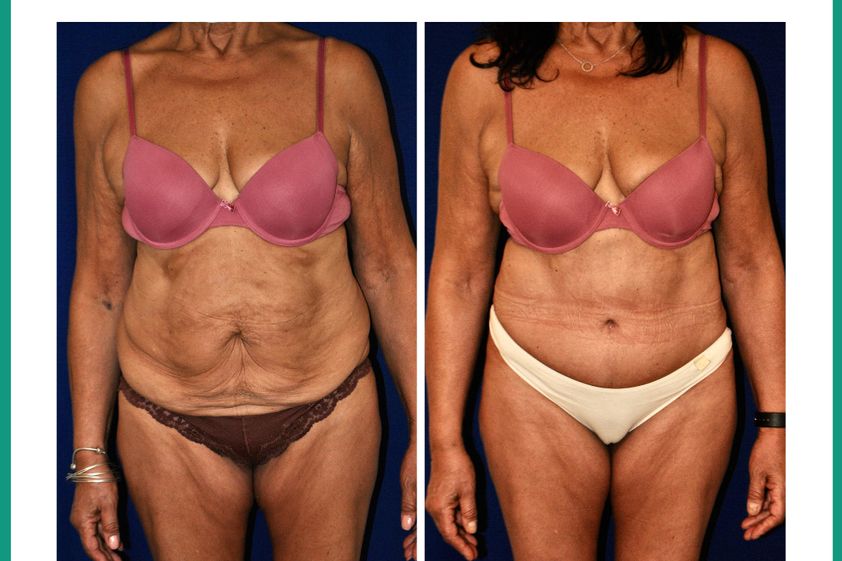 Abdominoplastía antes y después - 878959