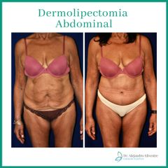 Dr. Alejandro Silvestre - Abdominoplastia