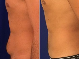 Lipoescultura antes y después - 878960