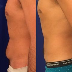Dr. Alejandro Silvestre - Lipoescultura