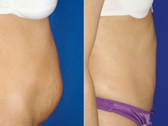 Abdominoplastía antes y después - 878963