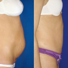 Dr. Alejandro Silvestre - Abdominoplastia