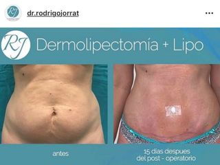 dermolipectomía + lipo