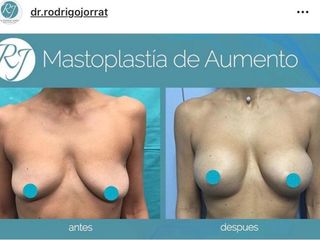 mastoplastía de aumento