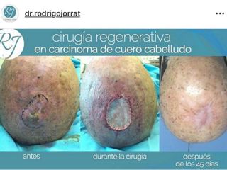 cirugia regenerativa en carcinoma de cuero cabelludo