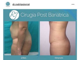 cirugia post bariátrica