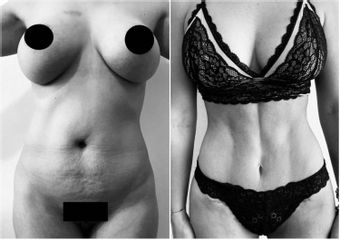 Liposucción - Dr. Rodrigo Jorrat
