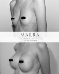 Aumento mamas - Clínica Marra