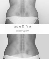 Lipoaspiración US (Ultra Sonica) - Clinica Marra