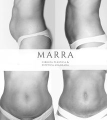 Lipoaspiración US (Ultra Sonica) - Clinica Marra