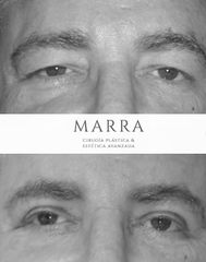 Blefaroplastia + Cola de Ceja - Clinica Marra