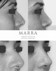 Rinoplastia - Clinica Marra