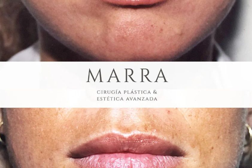 Relleno de labios antes y después - 867097