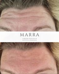 Botox - Clinica Marra