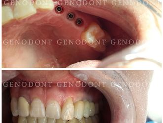 Prótesis dentales - 572251