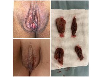 Labioplastia antes y después - 820947