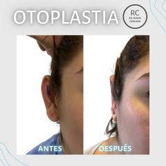 Otoplastia - Dra. Lorena Pedroza y Dr. Gonzalo Rueda