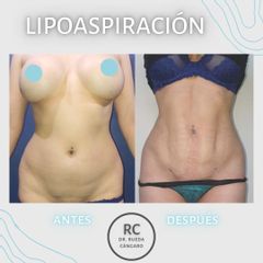 Liposucción - Dra. Lorena Pedroza y Dr. Gonzalo Rueda