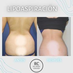 Liposucción - Dra. Lorena Pedroza y Dr. Gonzalo Rueda