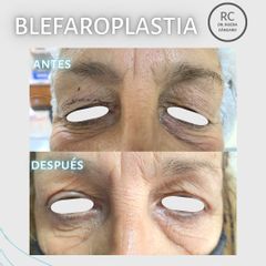 Blefaroplastia - Dra. Lorena Pedroza y Dr. Gonzalo Rueda