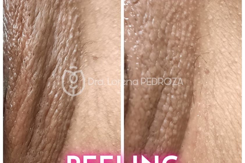 Peeling antes y después - 822229