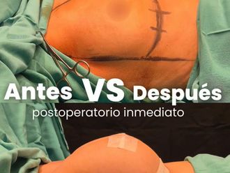 Aumento mamas antes y después - 877227