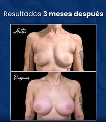 Aumento Mamario + Levantamiento - Dr. Damián Wengrowicz