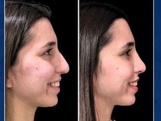 Rinoplastia antes y después - 877229