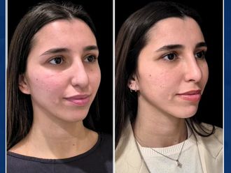 Rinoplastia antes y después - 877230