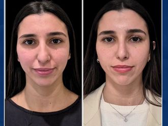 Rinoplastia antes y después - 877231